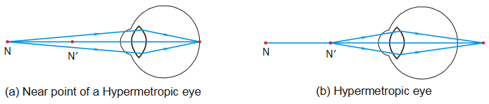 Hypermetropia of Far-Sightedness