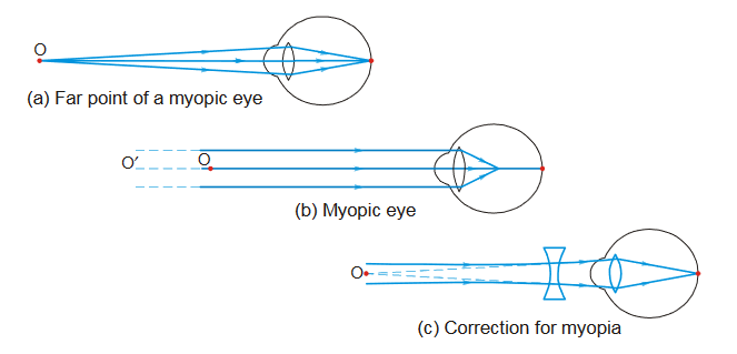 Myopia or Near-Sightedness